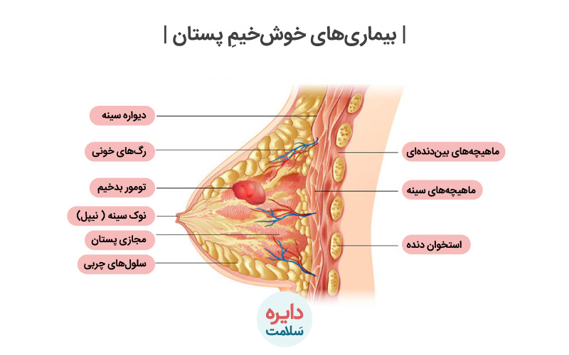 توده خوش خیم پستان